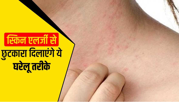 Allergy सही उपचार से ही मिलेगा आराम पढ़े With Spiritual Reasons And Ayurvedic Remedies